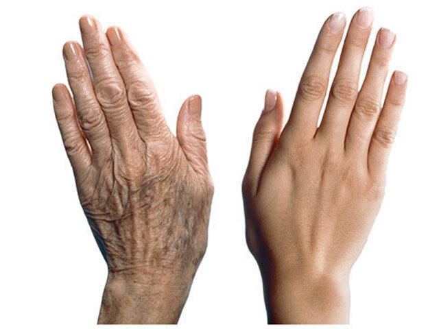 Причины и решение старения кожи рук